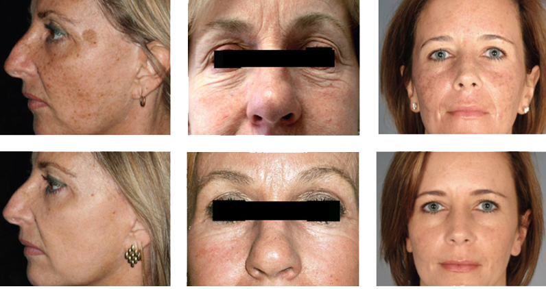 fractional co2 laser