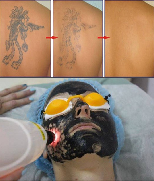 máy laser trị nám và xóa xăm