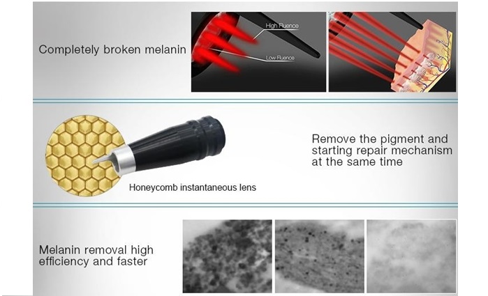 máy laser trị nám xóa xăm -22