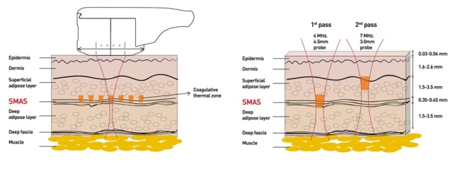 Máy nâng cơ mặt, Xóa nếp nhăn sử dụng công nghệ Hifu (High intensity focused untrasound)