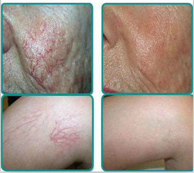 máy trị giãn mao mạch