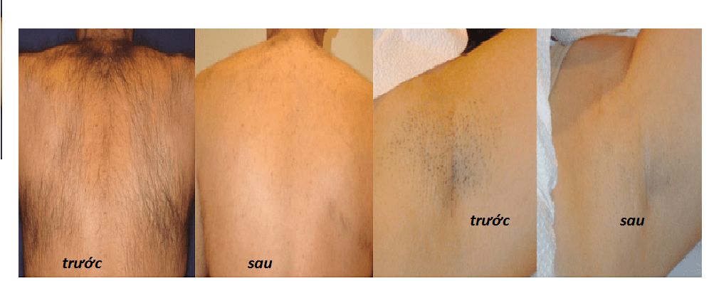 máy triệt lông