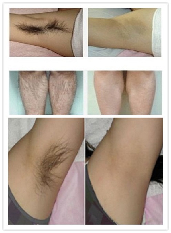 hình ảnh triệt lông