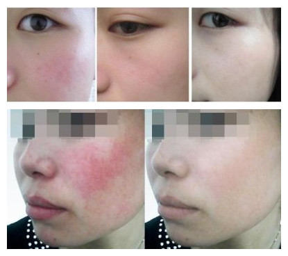 kết quả điều trị giãn mao mạch