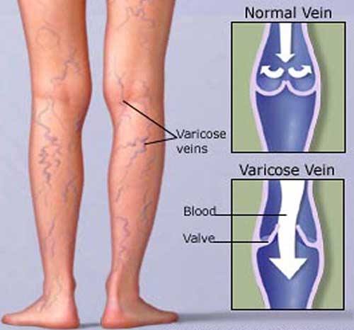 máy trị giãn mao mạch vùng chân