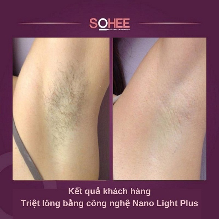 máy triệt lông toàn thân nano light plus